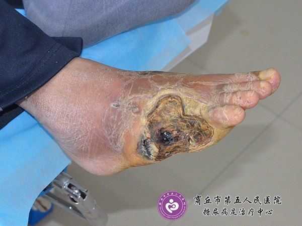图 截趾后烤干表面形成一层痂皮，但下面却发生着严重的感染